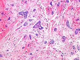Prostate cancer is a common type of cancer in men, according to the mayo clinic. Basal Cell Carcinoma Wikipedia