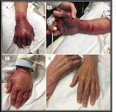 Figure 1 From Fosphenytoin Induced Purple Glove Syndrome A Case Report Semantic Scholar