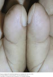 Image result for Clubbing nails feet