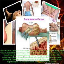 Learn about bone cancer by understanding normal bone tissue, how bone cancer develops, and the various types of bone cancer. How To Tell If You Have Bone Marrow Cancer