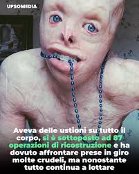 John Quinn aveva solo 4 anni quando stava giocando con sua sorella in un  capanno, dove accidentalmente una candela cadde sulla paglia e, in pochi  secondi, le fiamme avvolsero tutto il luogo.