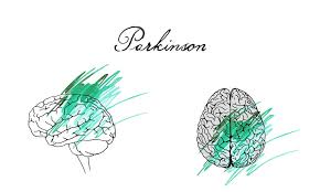 Parkinsons overview parkinson's disease affects the nerve cells in the brain that produce dopamine. Die Parkinson Krankheit Und Ihre Symptome Hc Marbella Hc Marbella International Hospital
