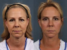 Lower face lift exercises, i want to show you how to lift up your face because as we age, this part droops down as the hyaluronic acid. Facelift In Louisville Lexington Ky Caloaesthetics Plastic Surgery Center