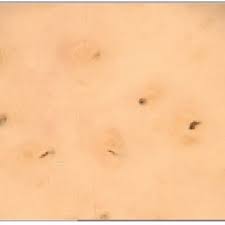 Slicked back hair continues to be one of the most popular men's hairstyles. Alopecia Areata Black Dots Are Observed Inside The Yellow Dots And Download Scientific Diagram