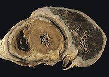 Check spelling or type a new query. Mesothelioma Wikipedia