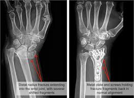 How to tell if my wrist is broken. I Broke My Wrist Now What Raleigh Orthopaedic