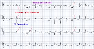 Image result for Post-MI Pericarditis