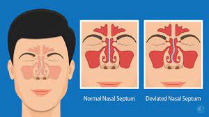 8 Signs Of A Deviated Septum Never To Ignore 5 Minute Read Sinus Problems Nasal Septum Chronic Sinusitis
