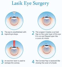 See full list on mayoclinic.org Smile Vision Correction May Leave You Little To Smile About Assil Eye Institute Blog