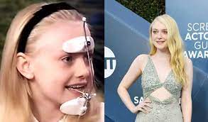 Some have worn the clear plastic aligners from invisalign, others have braces attached to the backs of their teeth, and others have had traditional metal braces for all the world to see. Celebrities With Braces Before And After Famous Brace Faces