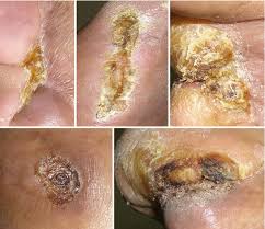 A dry scab or slough, esp one following a burn or cauterization of the skin word origin for eschar c16: Basics Of Wound Healing Springerlink