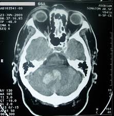 Para tac cerebral, en inglés lo más común/usao en las ordenes médicas es ct head, también se usan ct brain, cerebral ct . El Tac Perfusion Ofrece Informacion Fisiopatologica Que Mejora El Diagnostico Del Ictus