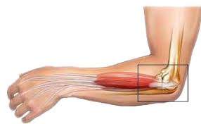 Teniski lakat, zdravo jutro, vladan jovićević, direktor doma zdravlja west medic Teniski Lakat Lateralni Epikondilitis Moj Fizioterapeut