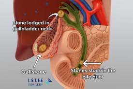 Image result for Gallstone
