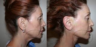 The extent of the results depends on the percentage of acid used in the solution. Marionette Lines Anew You Medical Aesthetics And Total Wellness Clinic
