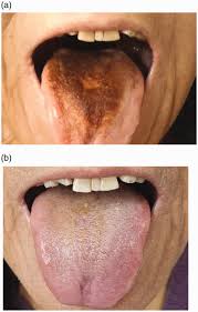 Image result for black hairy tongue symptoms