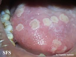The herpes simplex virus is categorized into 2 types: Herpetic Gingivostomatitis Wikidoc