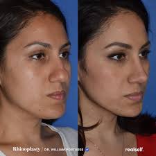 Pin On Rhinoplasty