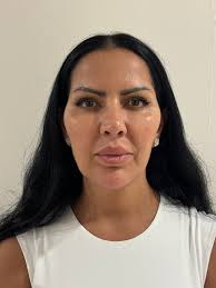 Hey, I'm having done 360 lipo + inner thighs lipo in February staying in  Windsor hotel istanbul, Anyone else going or staying in that hotel?