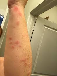 Dry clean all your clothes. Are These Bed Bug Bites This Happened Overnight I Have Scoured My Mattress And Bedding Looking For Any Signs Of Bed Bugs And I Can T Find Anything I M Washing Everything Now To