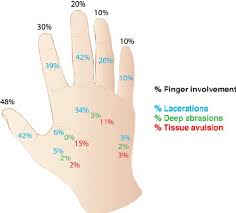 Thus when all four fingers and the thumb are extended, all. Percentage Of Injuries In The Fingers Mid Palm First Web Space Download Scientific Diagram
