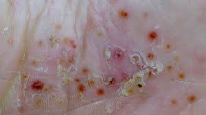 Image result for Pustular Psoriasis