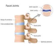 Image result for icd 10 code for facet arthrosis