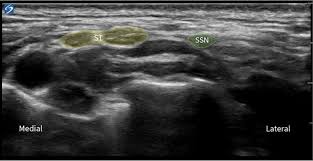 Image result for Superior Trunk Block