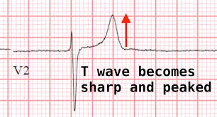 Image result for T Wave