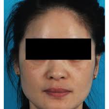 Dermatologic Therapy