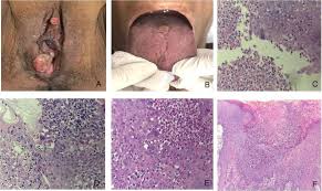 Infections are categorized based on the part of the body infected. Hypertrophic Genital Herpes In An Hiv Infected Female Patient Imiquimod As An Alternative Treatment International Journal Of Infectious Diseases