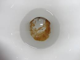 Der urinsteinentferner von hg ist kinderleicht in der anwendung und haftet aufgrund seiner besonderen formel äußerst lange an der toilettenoberfläche um urinstein. Hartnackiger Urin Stein Wie Bekomme Ich Ihn Endlich Weg Toilette Steine Urinstein