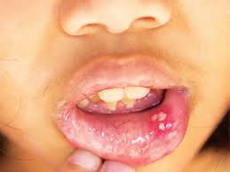 Gejala flu singapura penyakit tangan kaki dan mulut akibat virus. Aiskrim Lega Ulser Mulut