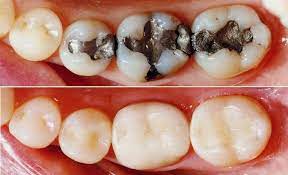 Do teeth fillings hurt metal. How Do Metal Fillings Affect Your Overall Health Downtown Dental Nashville