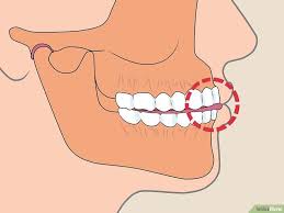 How To Stop Clenching Jaw 14 Steps With Pictures Wikihow Jaw Exercises Misaligned Teeth Stress Causes