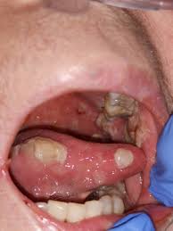 Image result for Oral herpes roof of mouth