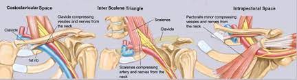 How To Truly Identify And Treat Thoracic Outlet Syndrome Tos Msk Neurology