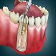 Root Canal