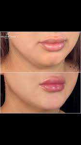 Flawless Patient Of The Day, 👄 Treatment ~ chin augmentation ⠀⠀⠀⠀, 😘  Patient request ~ more definition, 💉 Product used ~ JUVÉDERM® Voluma XC,  ⏱Results ~ immediate⠀⠀⠀⠀⠀⠀⠀⠀⠀⠀⠀⠀, ⌛️ Lasts ~ up to 24 ...