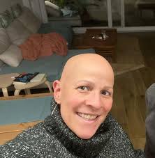 Rostros de la alopecia femenina en Málaga