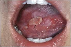 Image result for lichen planus on tongue)