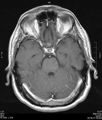Chronic fatigue syndrom in community. Chronische Steroidresponsive Lymphozytare Perivaskulare Pontine Entzundung Springerlink