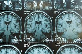 Image result for Thalamic Stimulation