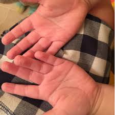 A single palmar crease occurs in about 1 out of 30 people, but is also frequently associated with other conditions such as down syndrome, aarskog syndrome or having a single palmar crease is often normal. Single Palma Crease August 2015 Babies Forums What To Expect