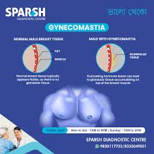 Image result for Gynecomastia