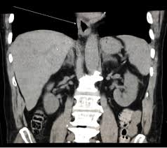 A recent review reveals 56 documented cases in the literature. Herpes Simplex Virus Esophagitis In An Immunocompetent Patient Infectious Diseases