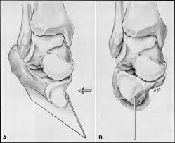 Clubfoot is a congenital condition (present at birth) that causes a baby's foot to turn inward or downward. The Classic Congenital Club Foot The Results Of Treatment Springerlink