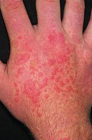 Check spelling or type a new query. 11 Syndromes D Hypersensibilite Et Vascularite Medicine Key