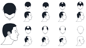 Androgenetic alopecia, or hereditary hair loss, is the most common type of hair loss and it's progressive. Different Types Of Hair Loss And It S Treatment Tibot
