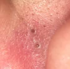 Was Ist Das Braune An Meinem Ohr Gesundheit Und Medizin Schmerzen Ohrmuschel
